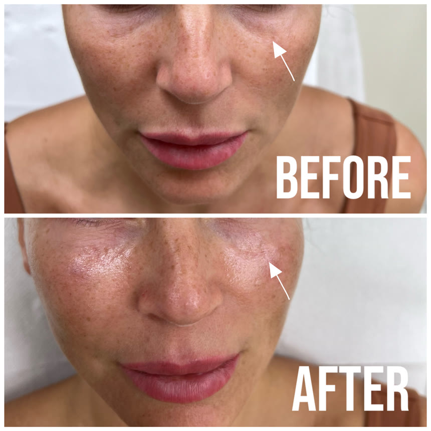 Cheek filler before and after — Dr. Belove result