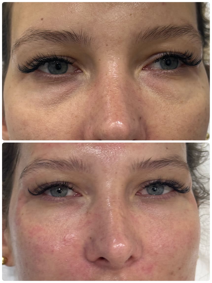 Under-eye filler before and after — Dr. Belove result