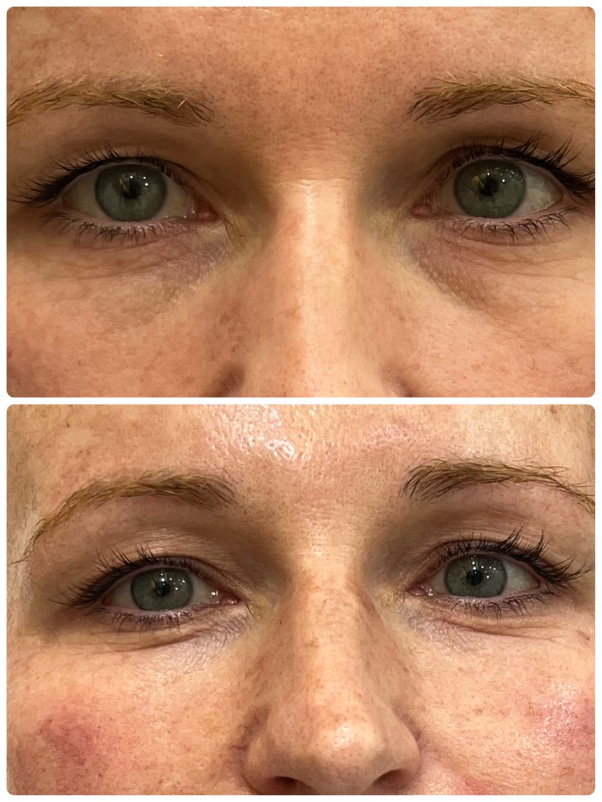 Botox before and after — Dr. Belove result