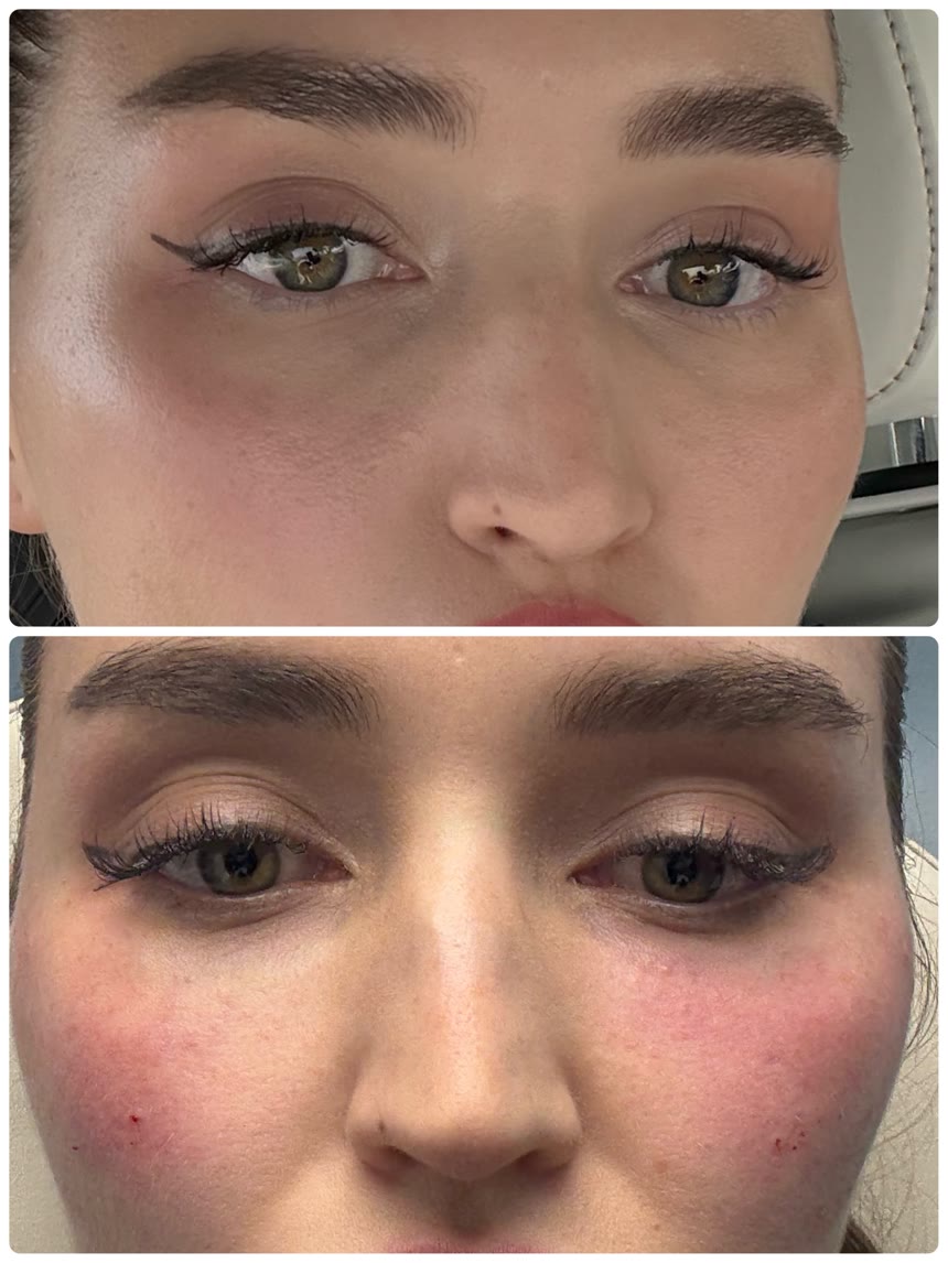 Under-eye filler before and after — Dr. Belove result