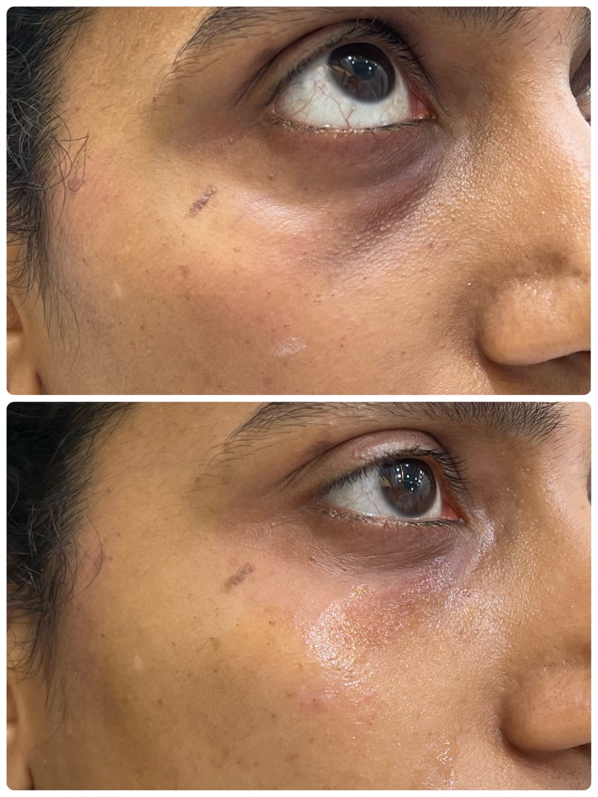 Under-eye filler before and after — Dr. Belove result