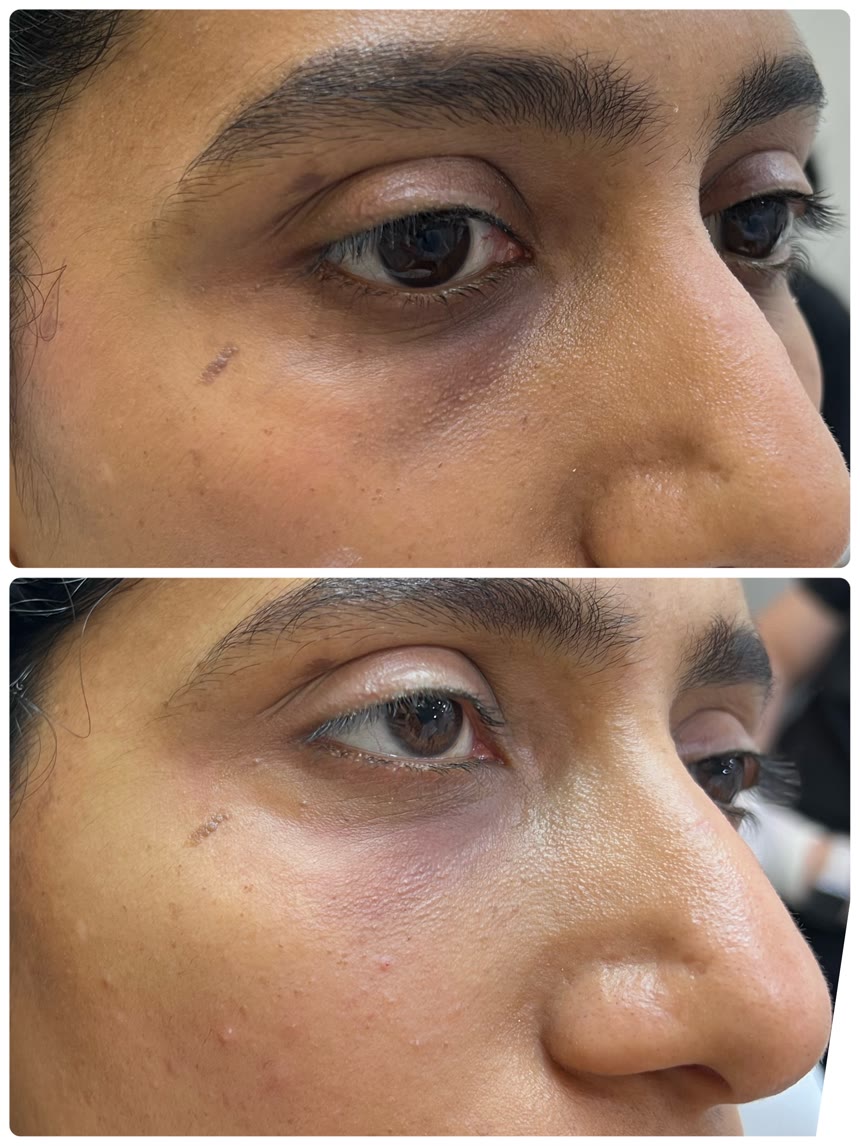 Under-eye filler before and after — Dr. Belove result