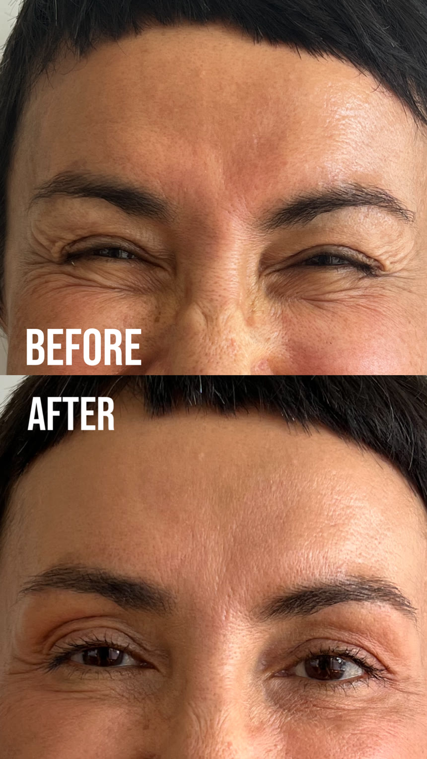 Botox before and after — Dr. Belove result