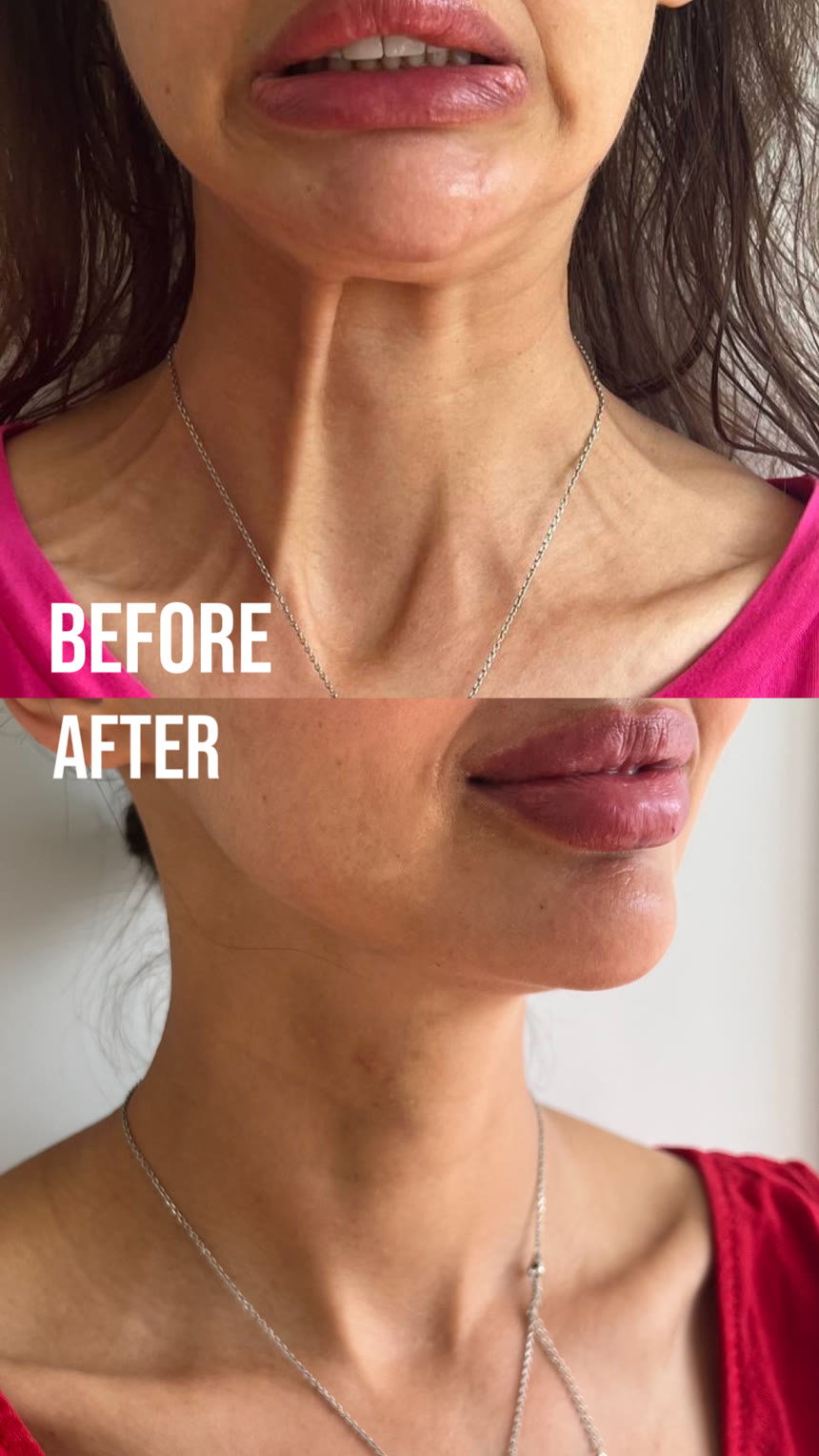 Botox before and after — Dr. Belove result