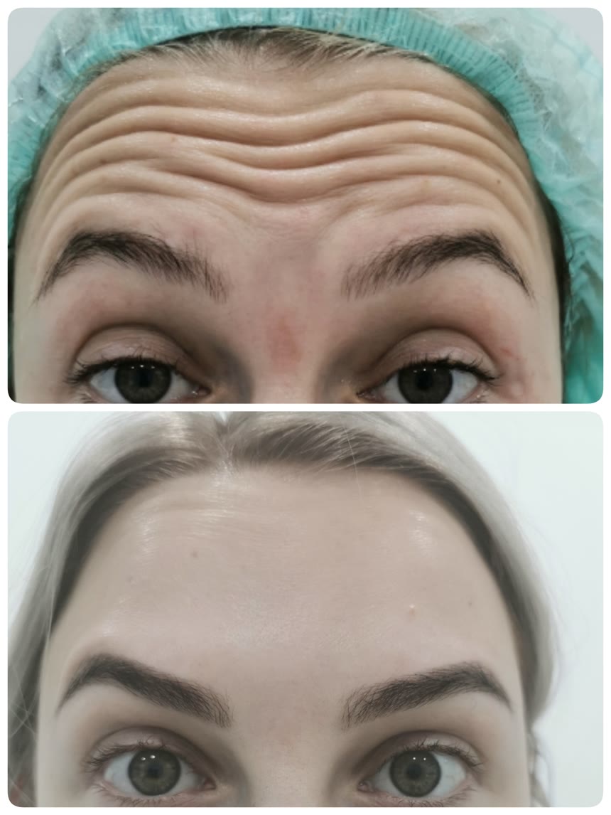 Botox before and after — Dr. Belove result