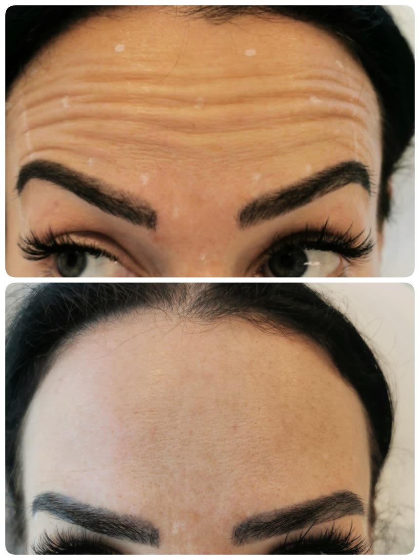 Botox before and after — Dr. Belove result