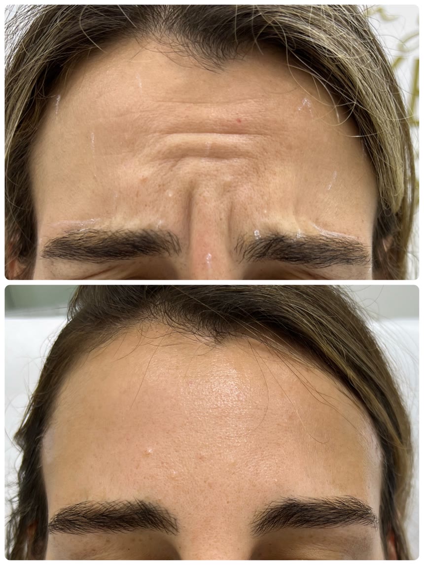 Botox before and after — Dr. Belove result