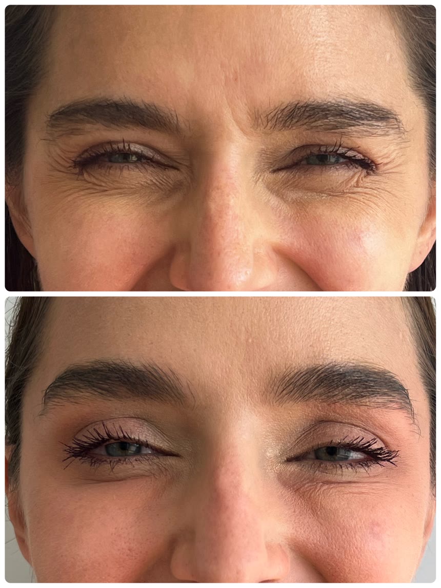 Botox before and after — Dr. Belove result