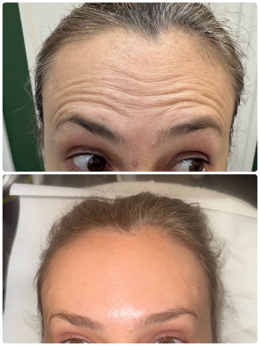 Botox before and after — Dr. Belove result